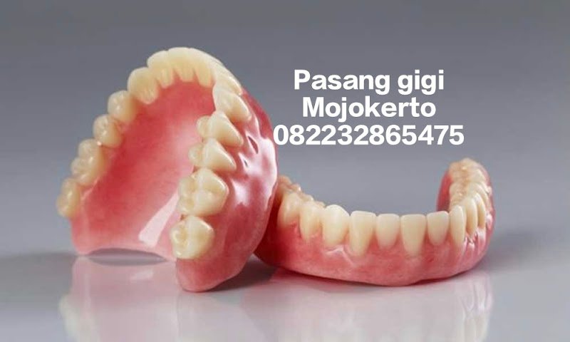 Pasang Gigi Mojokerto di Kota Mojokerto